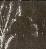 Ultraschallbild eines Säuglingshüftgelenk Typ I 