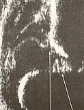 Ultraschallbild eines Säuglingshüftgelenk Typ IV